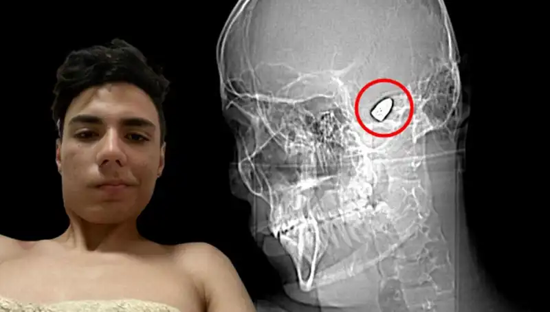 Kafasında Patlayıcıyı Taşıyan Genç, Hayat Mücadelesi Veriyor